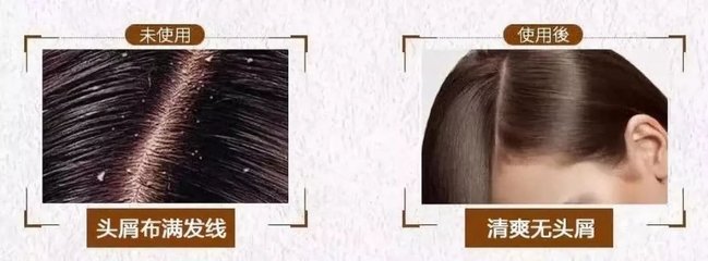 脫發(fā)、掉發(fā)、頭發(fā)稀少？用它洗洗，一次就離不開(kāi)